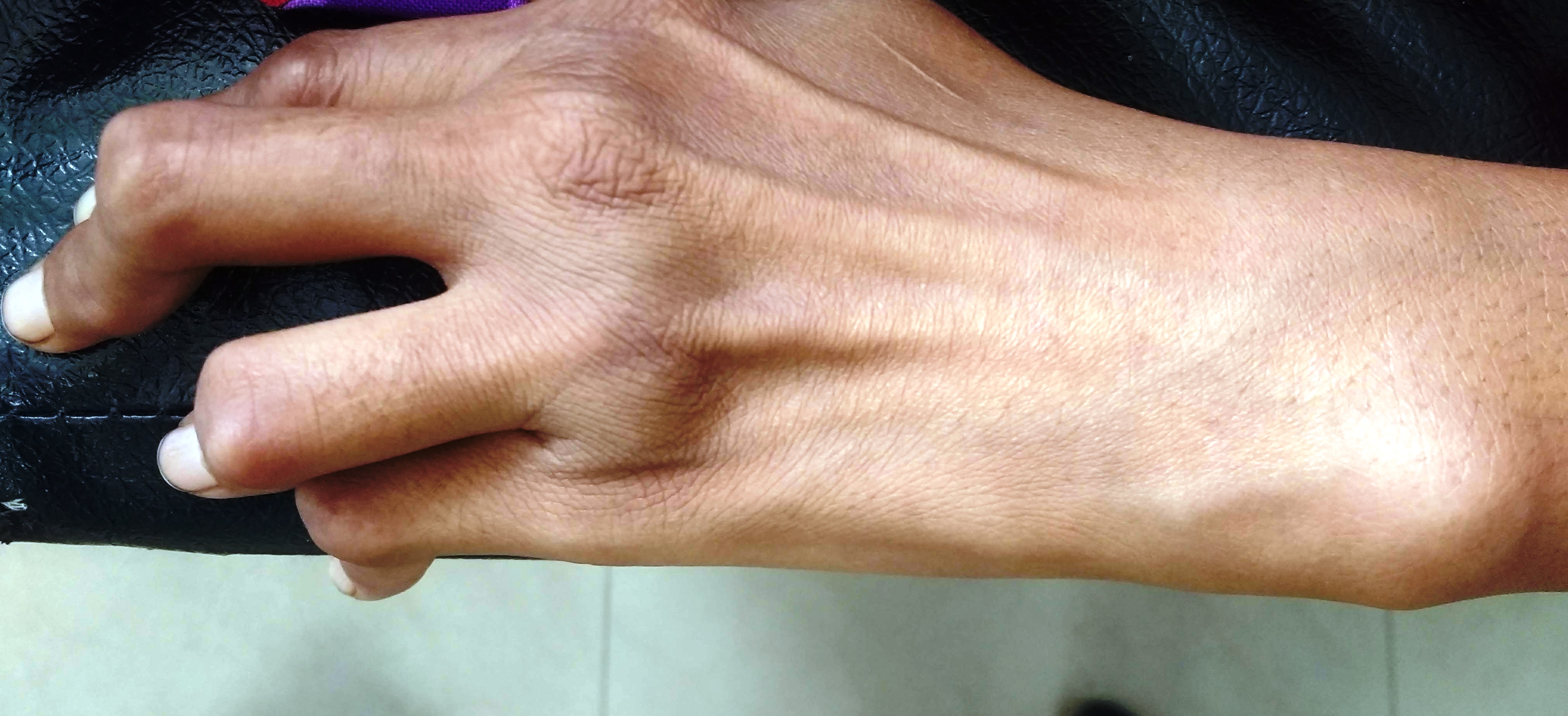 Rheumatoid Arthritis (Aamvata) — Ayurvedic Perspective
