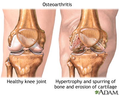 Osteoarthritis: Understanding and Treatment at Manomaya Ayurveda
